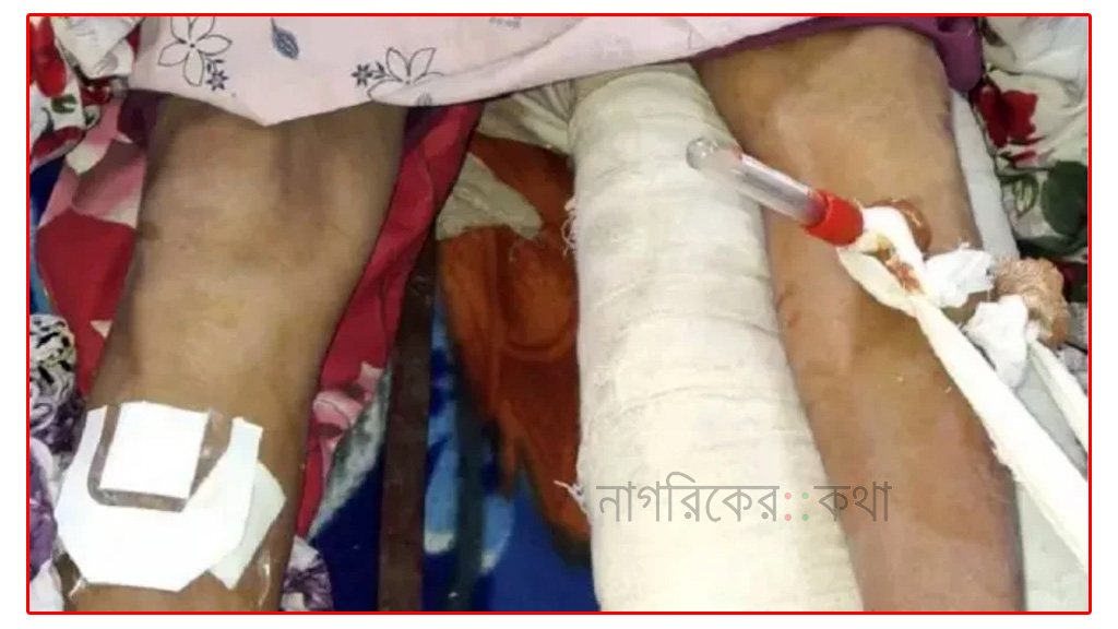 বাঁ পায়ের হাড় ভাঙা রোগীর ডান পায়ে অপারেশন